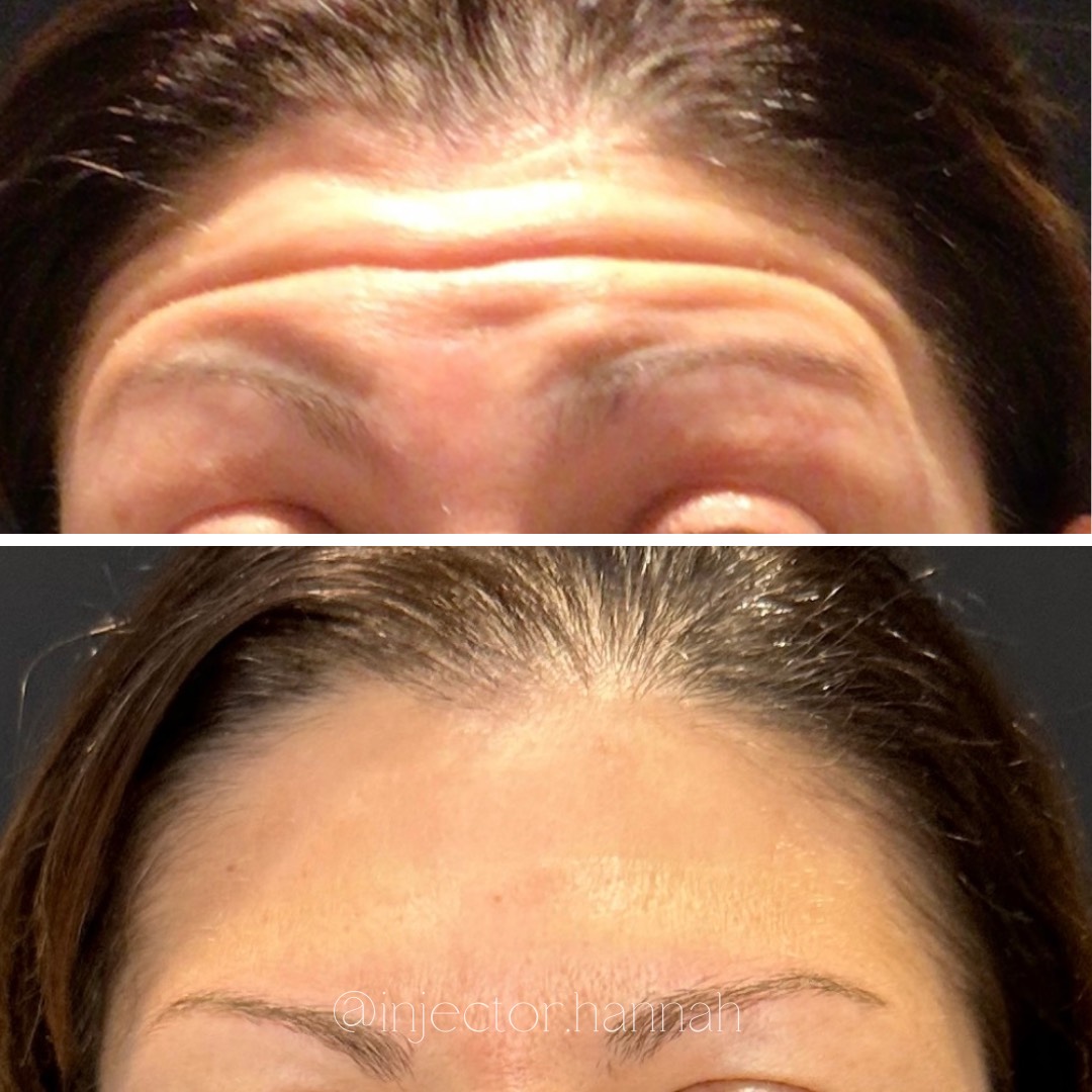 Forehead lines before/after – smoother after 2 weeks